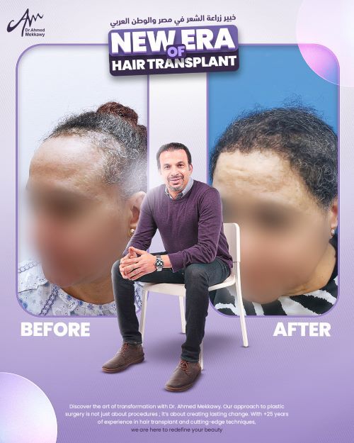ما هو افضل مركز لزراعة الشعر في مصر؟
